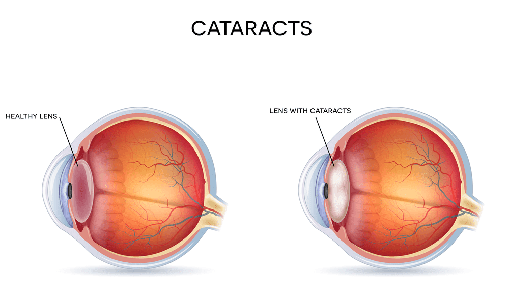 Cataracts |