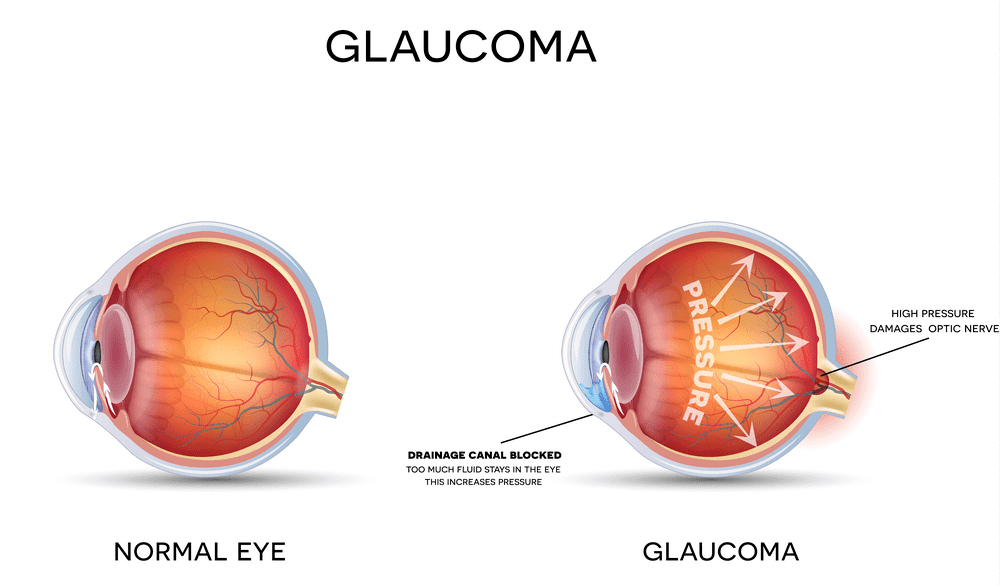 Glaucoma |